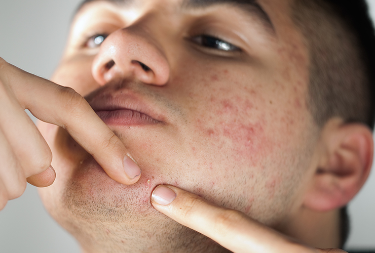 Can A Beard Cause Acne?