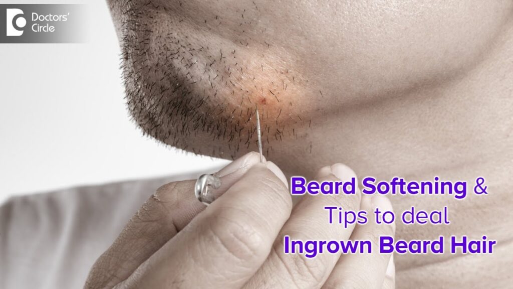 How To Deal With Ingrown Hairs In A Beard?