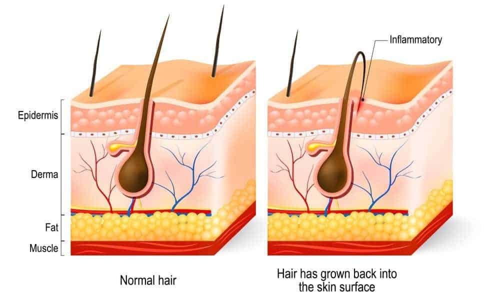 How To Deal With Ingrown Hairs In A Beard?