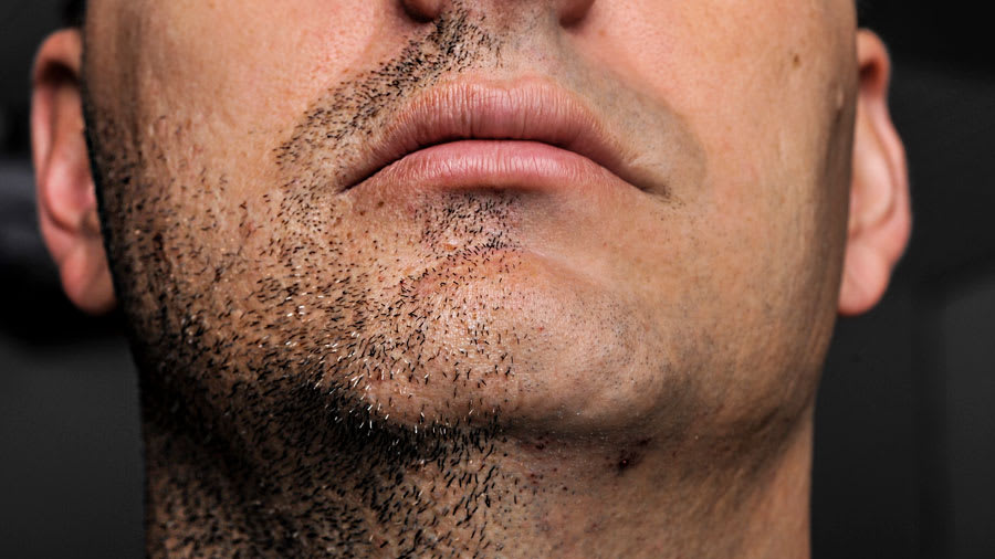 How To Deal With Ingrown Hairs In A Beard?