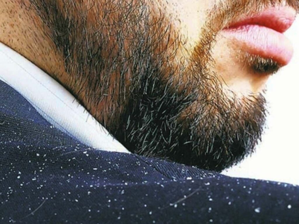 What Causes Beard Dandruff And How Can It Be Treated?