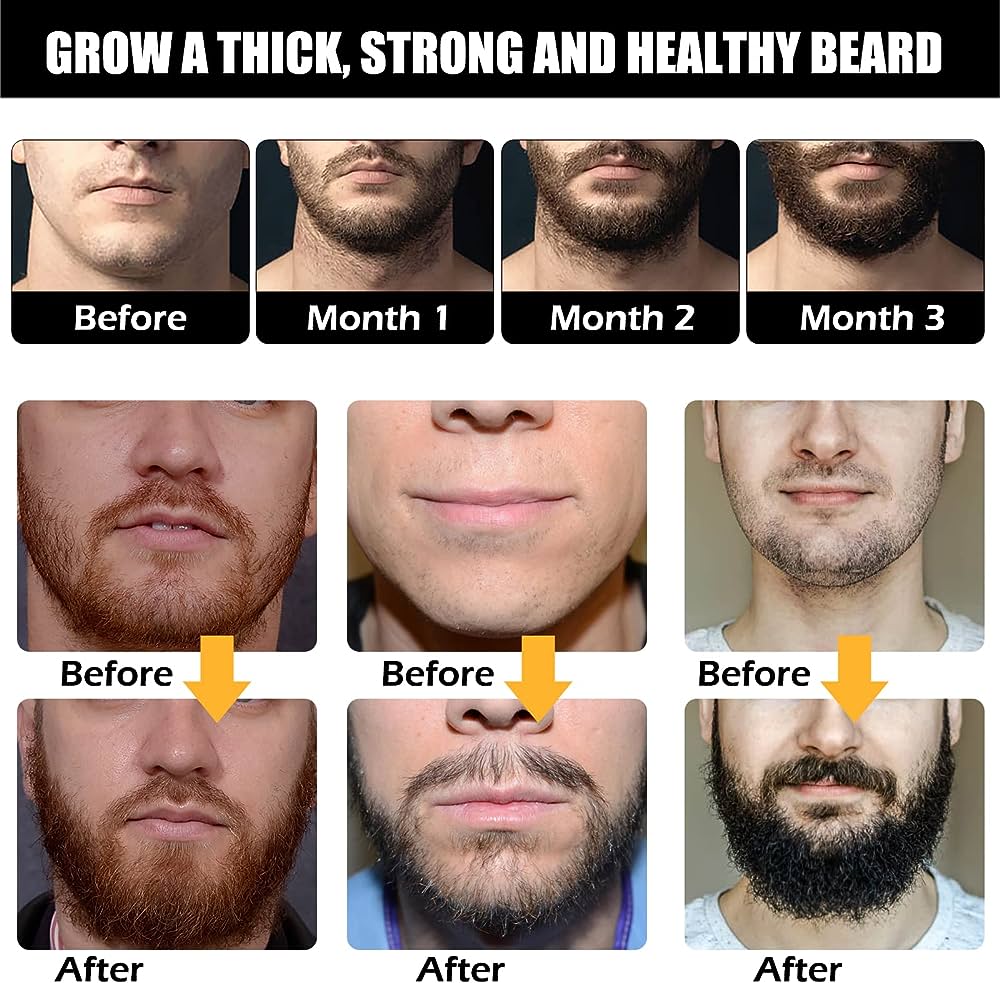 What Causes Uneven Beard Growth?