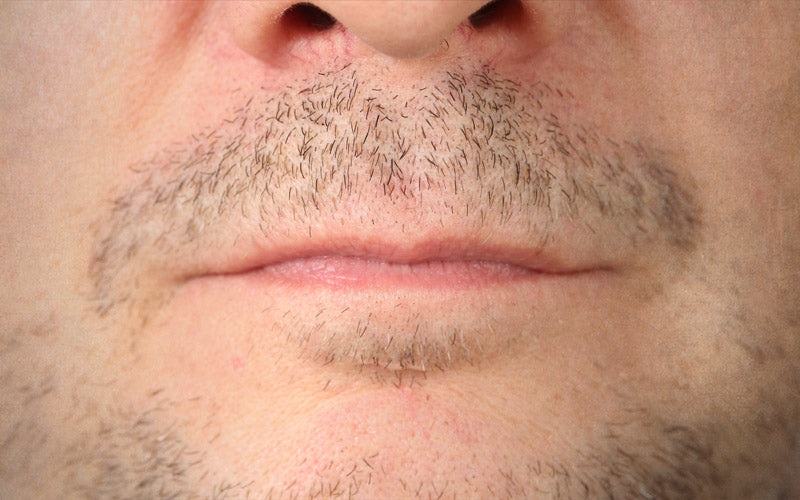 What Causes Uneven Beard Growth?