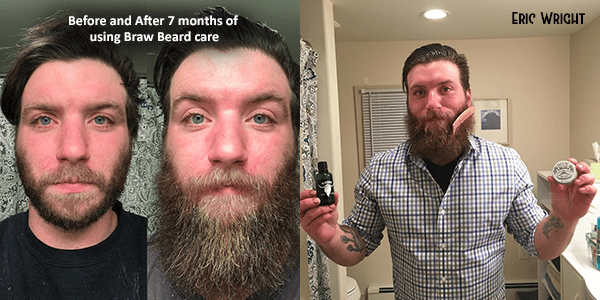 What Causes Uneven Beard Growth?