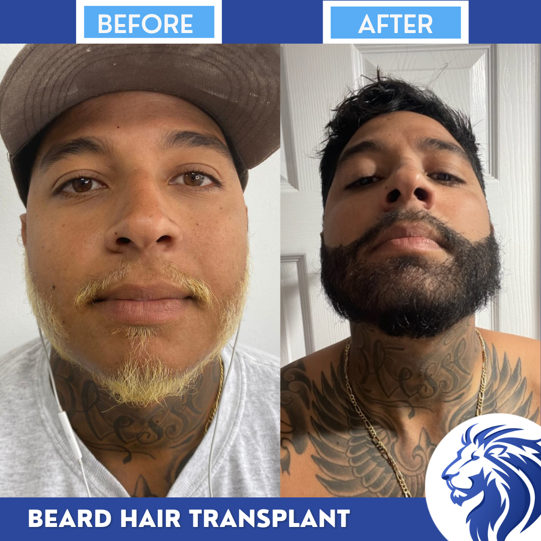 What Is A Beard Transplant?