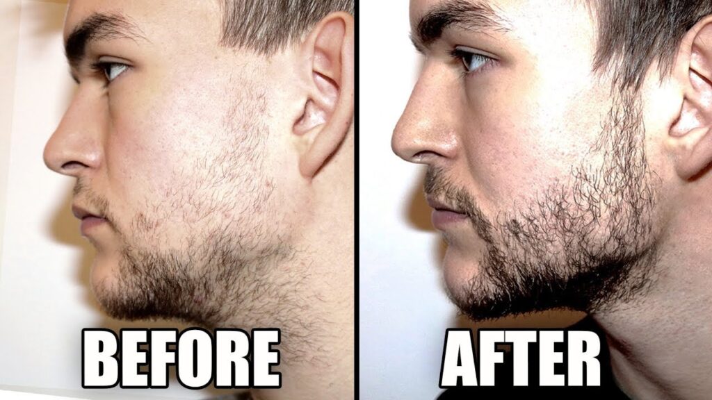Beard Growth Serum Before And After