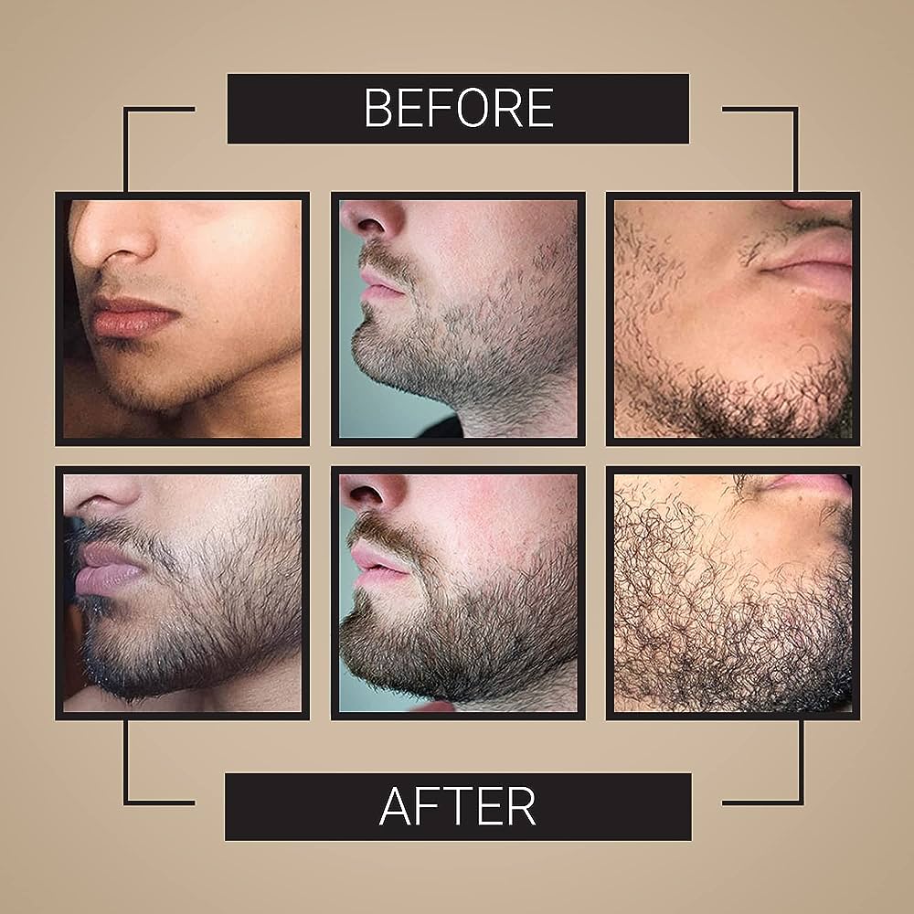 Beard Growth Serum Before And After
