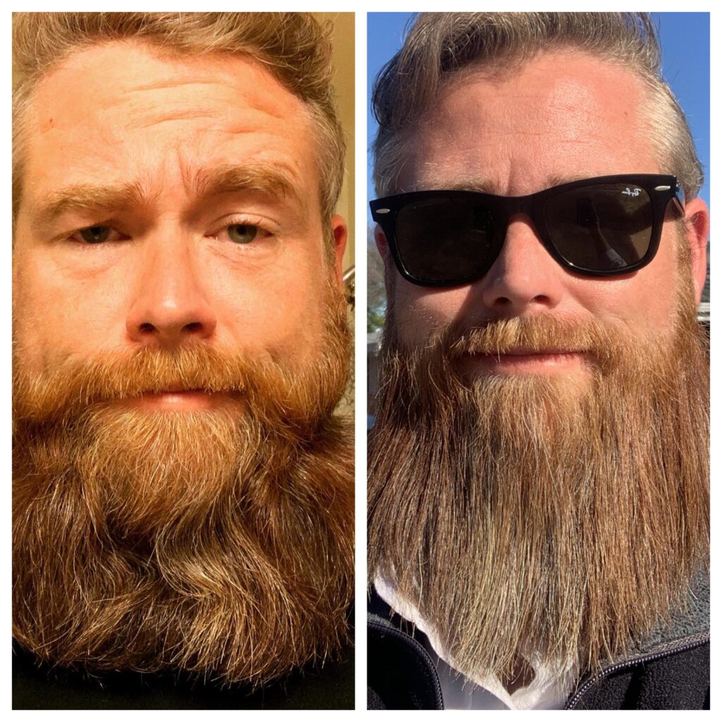 Beard Oil Growth Before And After