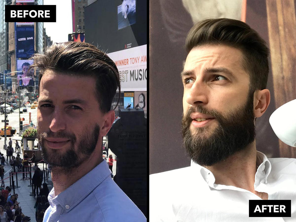 Best Way To Fix Patchy Beard