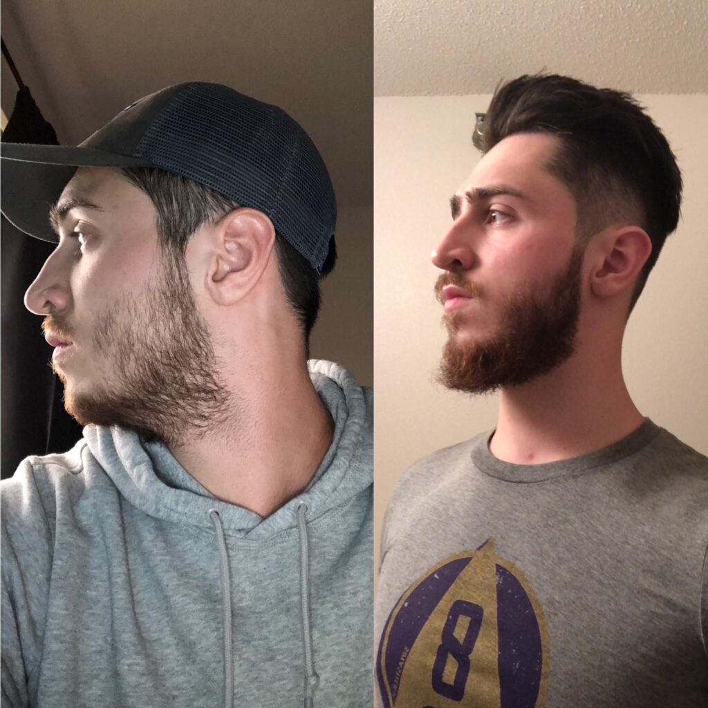 Growing Patchy Beard For A Year